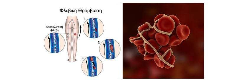 Miroslav Klose Thrombosis