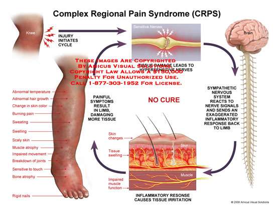 Pain syndrome. Regional Pain. Комплексный региональный болевой синдром.