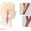 Καρωτιδική νόσος – Αγγειακά εγκεφαλικά επεισόδια